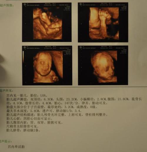 早孕b超单怎么看的相关图片