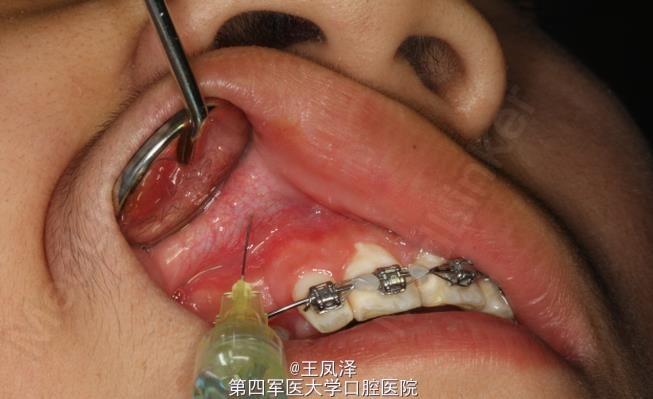牙齿正畸手术的相关图片