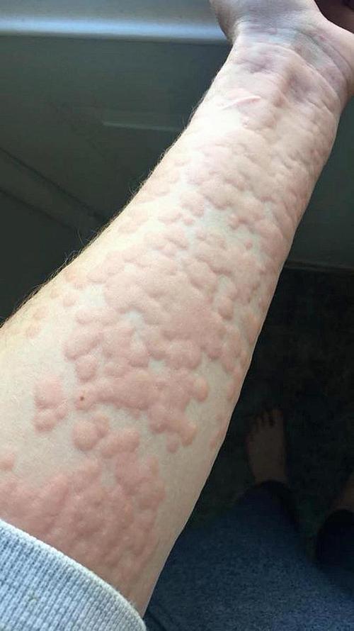 皮肤病荨麻疹的相关图片